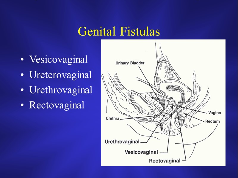 Genital Fistulas Vesicovaginal Ureterovaginal Urethrovaginal Rectovaginal